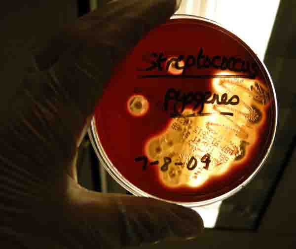 Streptococcus pyogenes causing Beta-hemolysis on Blood Agar