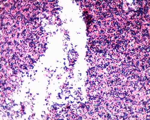 Gram stain mixed sample od Staphylococcus (Gram +, purple cocci) & E. coli, (Gram- pink rods) @ 1000xTM