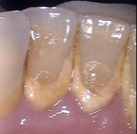 Dental Calculus, a Biofilm