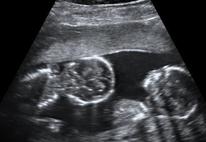 Abdominal ultrasonography of monoamniotic twins at a gestational age of 15 weeks.