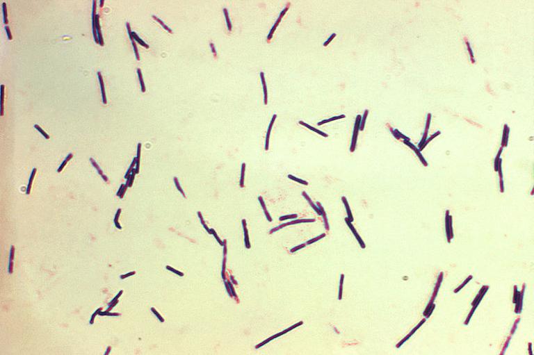 Gram stained clostridium perfringens, one of the agents of gas gangrene