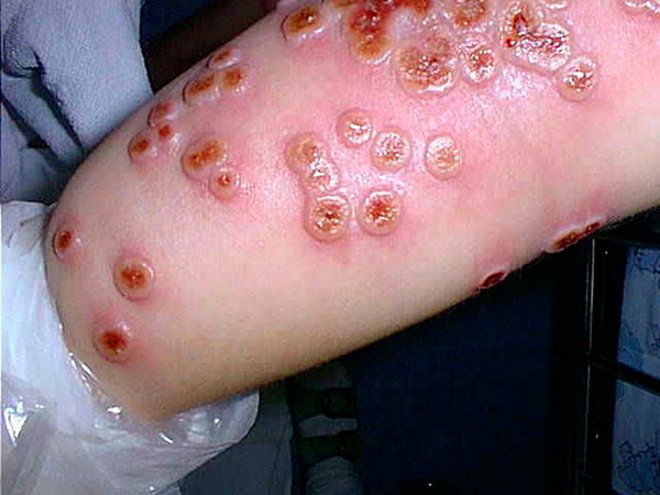 Cowpox Eruptions on Human Arm
