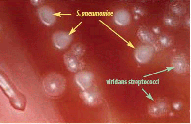 S. pneumoniae colonies have a flattened and depressed center after 24-48 hours of growth on a BAP, whereas the viridans streptococci retain a raised center