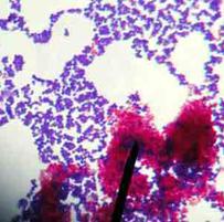 The waxy acid-fast cells stick together and clump. Acid-fast cell's stain pink and non-waxy (non-acid-fast) stain dark purple. Bacteria viewed at 1000xTM.