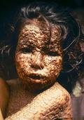 Girl infected with smallpox. Bangladesh, 1973.