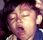 Young Boy Coughing Due to Pertusssis
